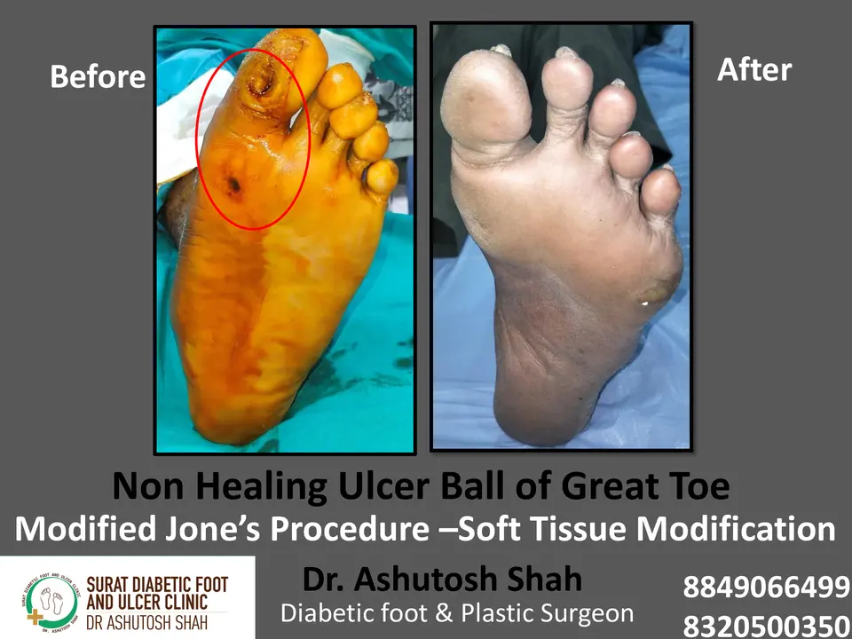 Diabetic Foot  PPT 3 checked by sir.pptx-76.webp